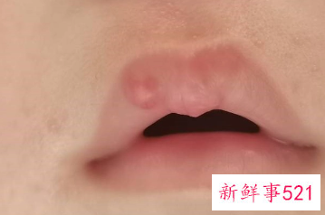 新生儿混合喂养嘴唇干咋回事