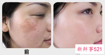 最先进的祛斑方法有哪些