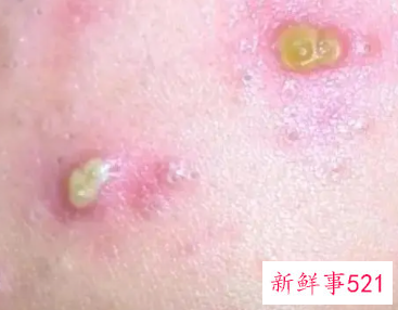 痘痘上有白色脓包还很痛