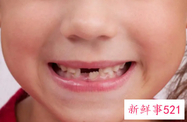 儿童换牙要注意哪些事项