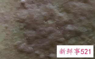 痘痘里有白色的脓包