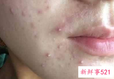 冬季轻松祛痘应该怎么做