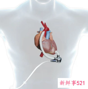 山东首例国产人工心脏植入患者在青岛出院