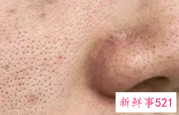男士脸部毛孔粗大螨虫脸油