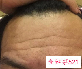 四十岁额头上的皱纹如何抚平