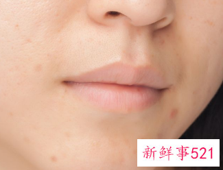 脸上的黑斑怎么能去掉