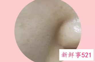 毛孔大真的缩不回来