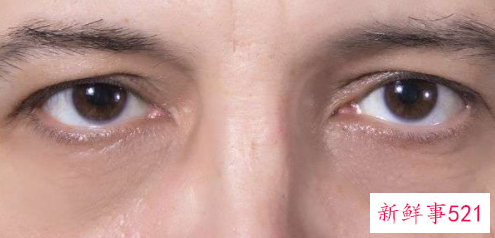 祛除眼袋用什么产品最快最好