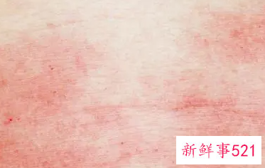 什么是湿疹性皮炎