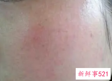面部皮肤过敏发红怎么办