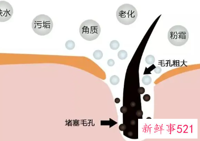 怎么清理皮肤毛孔垃圾