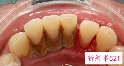 怎么样洗去牙垢