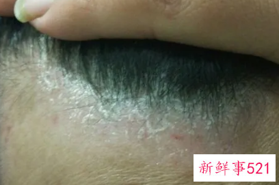 洗头后头皮有一层白色干皮
