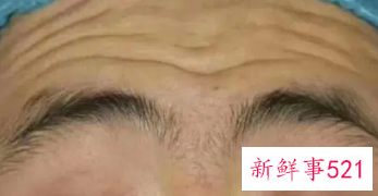 抬头纹有什么办法可以消除