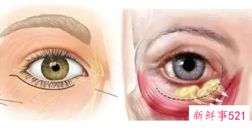 去眼袋最有效的方法有哪些