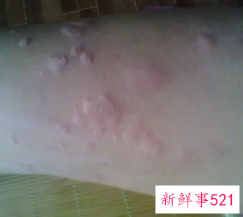 梦见腿上长好多疙瘩