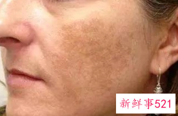 怎样改善鸡皮肤褐色斑点