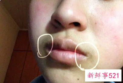 嘴角黑色素去除的小妙招