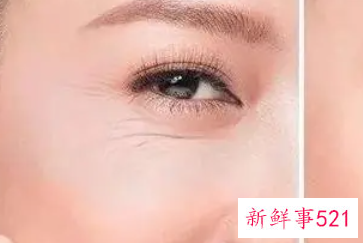 激光去除鱼尾纹有什么优势