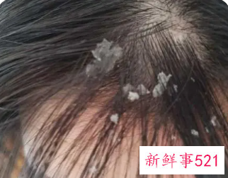 洗头后头皮有一层白色干皮