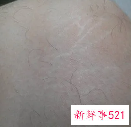 长肥胖纹的原因是皮肤病吗