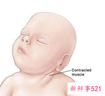宝宝脖子歪右边纠正图