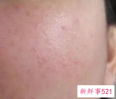 过敏皮肤变红怎么消退