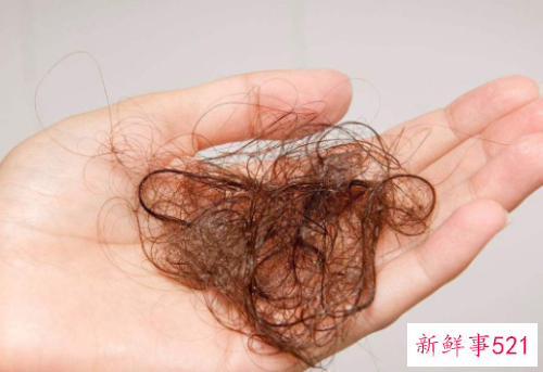 头发出油脱发怎么治