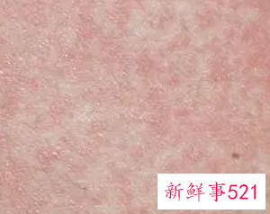 全身皮肤变粗糙什么问题