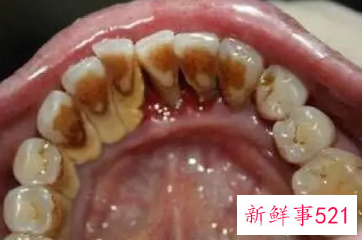 怎么样洗去牙垢