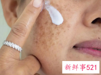脸上的黑斑怎么能去掉