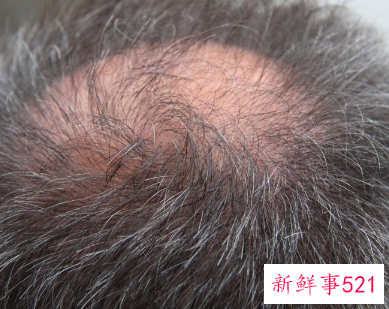 解决头发干枯毛躁小妙招