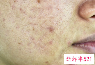 痘痘上有白色脓包还很痛