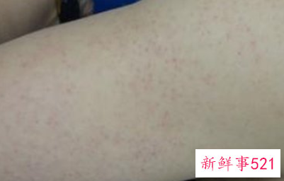 怎样改善鸡皮肤褐色斑点