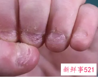 孩子爱咬手指甲是什么原因