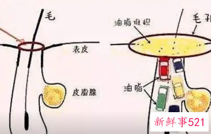 怎么清理皮肤毛孔垃圾