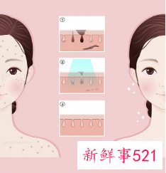 什么是激光祛斑