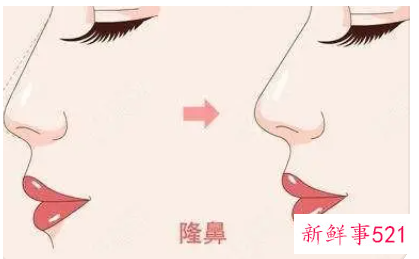 耳软骨隆鼻可以维持一辈子吗