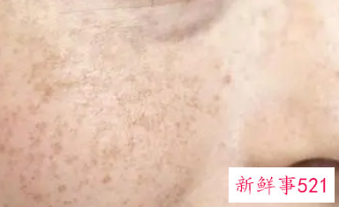 有什么办法去黑色素