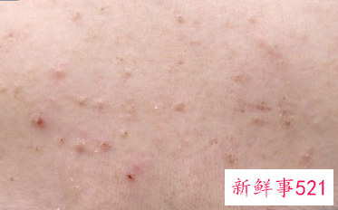 脸上起来了好多小米粒