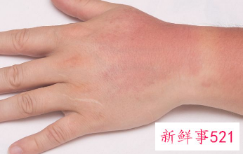 手掌皮肤粗糙角质厚硬