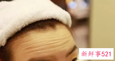 抬头纹有什么办法可以消除