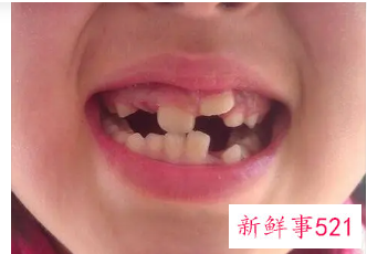 为什么孩子换牙后牙就长歪了
