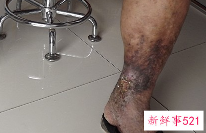 静脉曲张的危害有哪些