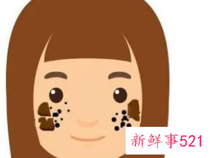 脸上长斑和黑色素怎么去除