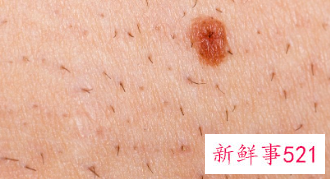 去瘊子最快的方法