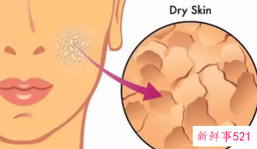 脸部缺水刺痛如何处理