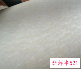 长肥胖纹的原因是皮肤病吗