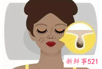 怎么改善皮肤毛孔粗大黑头