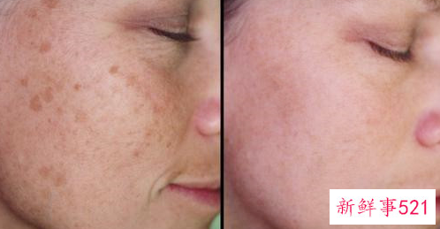 最先进的祛斑方法有哪些